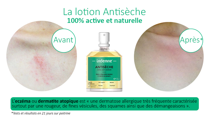 Lotion naturelle antisèche pour la peau irritée, les démangeaisons